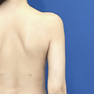 新宿ラクル美容外科クリニック　山本厚志　「ライポライフ脂肪吸引（二の腕+背中上部）」　手術後３ヶ月目　１月３１日