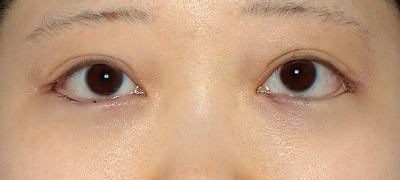 新宿ラクル美容外科クリニック　山本厚志　下眼瞼下制術（グラマラスライン形成術（皮膚切開法））+目尻切開　手術直後　５月１日