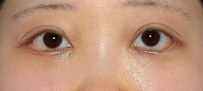 新宿ラクル美容外科クリニック　山本厚志　下眼瞼下制術（グラマラスライン形成術（皮膚切開法））+目尻切開　手術後１週間目　５月１日