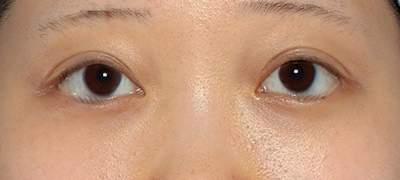 新宿ラクル美容外科クリニック　山本厚志　下眼瞼下制術（グラマラスライン形成術（皮膚切開法））+目尻切開　手術後２ヶ月目　５月１日
