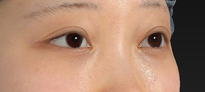 新宿ラクル美容外科クリニック　山本厚志　下眼瞼下制術（グラマラスライン形成術（皮膚切開法））+目尻切開　手術前　５月１日