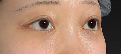 新宿ラクル美容外科クリニック　山本厚志　下眼瞼下制術（グラマラスライン形成術（皮膚切開法））+目尻切開　手術後１ヶ月目　５月１日