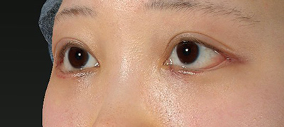新宿ラクル美容外科クリニック　山本厚志　下眼瞼下制術（グラマラスライン形成術（皮膚切開法））+目尻切開　手術後１週間目　５月１日