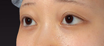 新宿ラクル美容外科クリニック　山本厚志　下眼瞼下制術（グラマラスライン形成術（皮膚切開法））+目尻切開　手術後２ヶ月目　５月１日