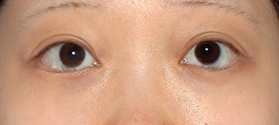 新宿ラクル美容外科クリニック　山本厚志　下眼瞼下制術（グラマラスライン形成術（皮膚切開法））+目尻切開　手術後６ヶ月目　９月２８日