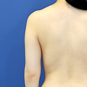 新宿ラクル美容外科クリニック　山本厚志　「ライポライフ脂肪吸引（二の腕+背中上部）」　手術前　５月１日