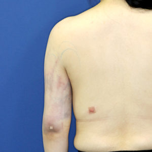 新宿ラクル美容外科クリニック　山本厚志　「ライポライフ脂肪吸引（二の腕+背中上部）」　手術直後　５月１日