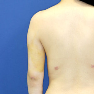 新宿ラクル美容外科クリニック　山本厚志　「ライポライフ脂肪吸引（二の腕+背中上部）」　手術後１週間目　５月１日