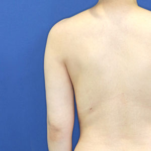新宿ラクル美容外科クリニック　山本厚志　「ライポライフ脂肪吸引（二の腕+背中上部）」　手術後１２ヶ月目　６月１５日