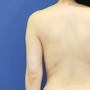新宿ラクル美容外科クリニック　山本厚志　「ライポライフ脂肪吸引（二の腕+背中上部）」　手術後２ヶ月目　６月１５日