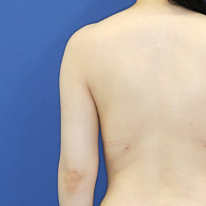 新宿ラクル美容外科クリニック　山本厚志　「ライポライフ脂肪吸引（二の腕+背中上部）」　手術後３ヶ月目　６月１５日