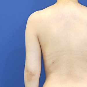 新宿ラクル美容外科クリニック　山本厚志　「ライポライフ脂肪吸引（二の腕+背中上部）」　手術後６ヶ月目　６月１５日