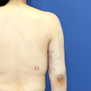 新宿ラクル美容外科クリニック　山本厚志　「ライポライフ脂肪吸引（二の腕+背中上部）」　手術直後　５月１日