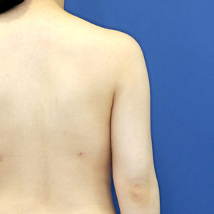 新宿ラクル美容外科クリニック　山本厚志　「ライポライフ脂肪吸引（二の腕+背中上部）」　手術後１ヶ月目　５月１日