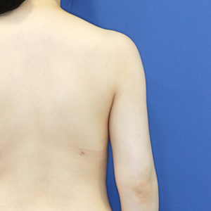 新宿ラクル美容外科クリニック　山本厚志　「ライポライフ脂肪吸引（二の腕+背中上部）」　手術後３ヶ月目　６月１５日