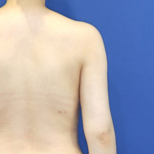 新宿ラクル美容外科クリニック　山本厚志　「ライポライフ脂肪吸引（二の腕+背中上部）」　手術後２ヶ月目　６月１５日