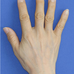 新宿ラクル美容外科クリニック　山本厚志　「手の若返り（プレミアムPRP×FGF皮膚再生療法）」　治療後１ヶ月目　７月４日