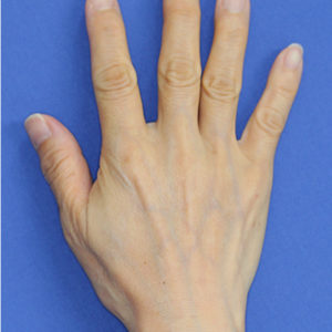 新宿ラクル美容外科クリニック　山本厚志　「手の若返り（プレミアムPRP×FGF皮膚再生療法）」　治療後３ヶ月目　７月４日