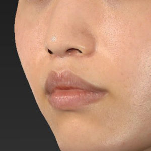 新宿ラクル美容外科クリニック　山本厚志　「猫手術（鼻唇角形成術）+ 人中短縮術（リップリフト）」　手術後２ヶ月目　８月３日