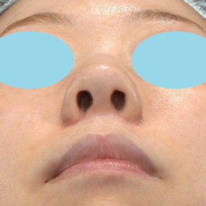 新宿ラクル美容外科クリニック　山本厚志　「小鼻縮小+α法」　手術後１ヶ月目　９月９日