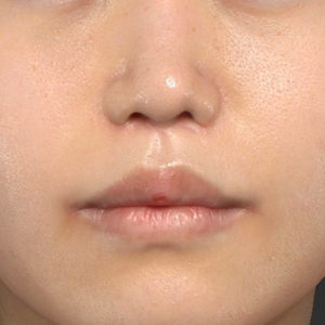 新宿ラクル美容外科クリニック　山本厚志　「猫手術（鼻唇角形成術）+ 人中短縮術（リップリフト）+口角挙上（スマイルリフト）」　手術後２ヶ月目　９月２１日