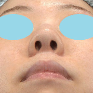 新宿ラクル美容外科クリニック　山本厚志　「小鼻縮小+α法」　手術後３ヶ月目　９月９日