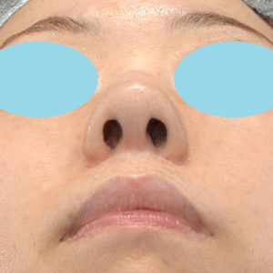 新宿ラクル美容外科クリニック　山本厚志　「小鼻縮小+α法」　手術後６ヶ月目　１２月４日