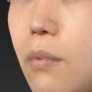 新宿ラクル美容外科クリニック　山本厚志　「猫手術（鼻唇角形成術）+ 人中短縮術（リップリフト）+口角挙上（スマイルリフト）」　手術前　９月２１日