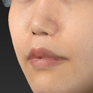 新宿ラクル美容外科クリニック　山本厚志　「猫手術（鼻唇角形成術）+ 人中短縮術（リップリフト）+口角挙上（スマイルリフト）」　手術後１２ヶ月目　１２月２３日