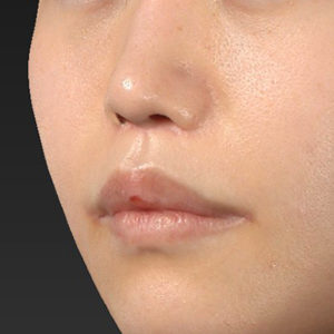 新宿ラクル美容外科クリニック　山本厚志　「猫手術（鼻唇角形成術）+ 人中短縮術（リップリフト）+口角挙上（スマイルリフト）」　手術後２ヶ月目　９月２１日