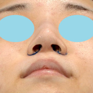 新宿ラクル美容外科クリニック　山本厚志　「小鼻縮小+α法」　デザイン　１０月２１日