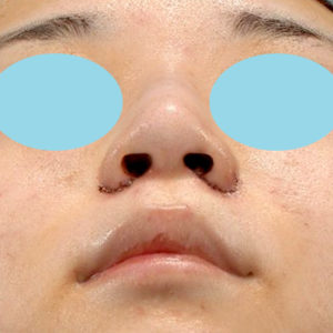 新宿ラクル美容外科クリニック　山本厚志　「小鼻縮小+α法」　手術直後　１０月２１日