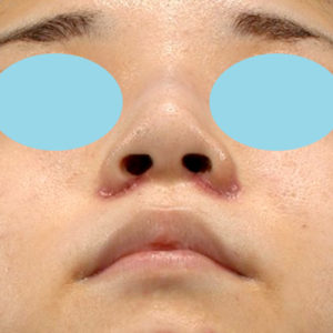 新宿ラクル美容外科クリニック　山本厚志　「小鼻縮小+α法」　手術後１週間目　１０月２１日