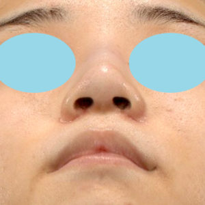 新宿ラクル美容外科クリニック　山本厚志　「小鼻縮小+α法」　手術後１ヶ月目　１０月２１日
