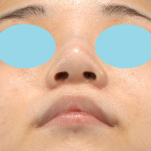 新宿ラクル美容外科クリニック　山本厚志　「小鼻縮小+α法」　手術後２ヶ月目　１０月２１日