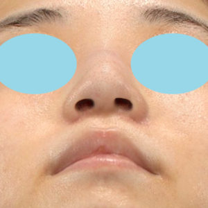 新宿ラクル美容外科クリニック　山本厚志　「小鼻縮小+α法」　手術後３ヶ月目　１０月２１日