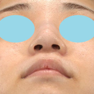 新宿ラクル美容外科クリニック　山本厚志　「小鼻縮小+α法」　手術後６ヶ月目　３月２９日