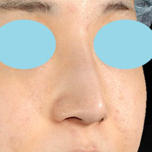 新宿ラクル美容外科クリニック　山本厚志　「小鼻縮小+α法」　手術前　１０月２１日