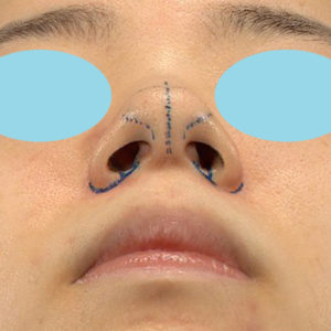 「小鼻縮小+α＋鼻尖縮小（close法）」　新宿ラクル美容外科クリニック　２０代女性　デザイン　１１月１５日