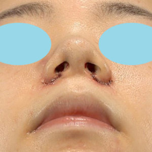 「小鼻縮小+α＋鼻尖縮小（close法）」　新宿ラクル美容外科クリニック　２０代女性　手術直後　１１月１５日