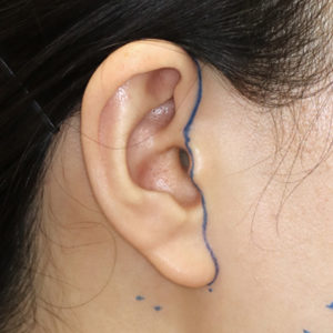 新宿ラクル美容外科クリニック　山本厚志　ナチュラルフェイスリフト　耳の傷痕　デザイン　１月２４日