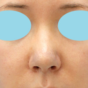 「鼻孔縁下降術」　新宿ラクル美容外科クリニック　３０代女性　手術直後　１月２４日