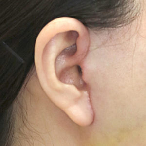 新宿ラクル美容外科クリニック　山本厚志　ナチュラルフェイスリフト　耳の傷痕　手術後１週間目　１月２４日