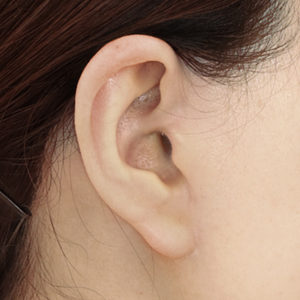 新宿ラクル美容外科クリニック　山本厚志　ナチュラルフェイスリフト　耳の傷痕　手術後１２ヶ月目　１月２４日