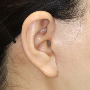 新宿ラクル美容外科クリニック　山本厚志　ナチュラルフェイスリフト　耳の傷痕　手術後１ヶ月目　１月２４日