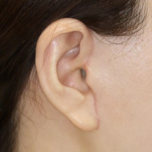 新宿ラクル美容外科クリニック　山本厚志　ナチュラルフェイスリフト　耳の傷痕　手術後２ヶ月目　１月２４日