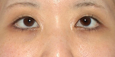 新宿ラクル美容外科クリニック　山本厚志　「切らない目の下のたるみ取り」「クレヴィエルプライム」　手術後１ヶ月目　２月１３日