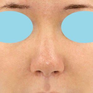 「鼻孔縁下降術」　新宿ラクル美容外科クリニック　３０代女性　手術後２ヶ月目　３月１１日