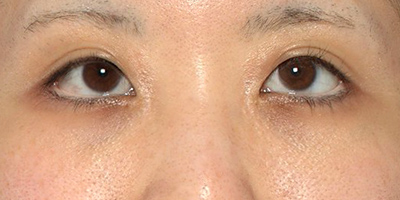 新宿ラクル美容外科クリニック　山本厚志　「切らない目の下のたるみ取り」「クレヴィエルプライム」　手術後３ヶ月目　２月１３日