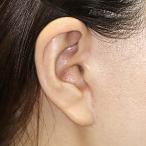 新宿ラクル美容外科クリニック　山本厚志　ナチュラルフェイスリフト　耳の傷痕　手術後６ヶ月目　１月２４日